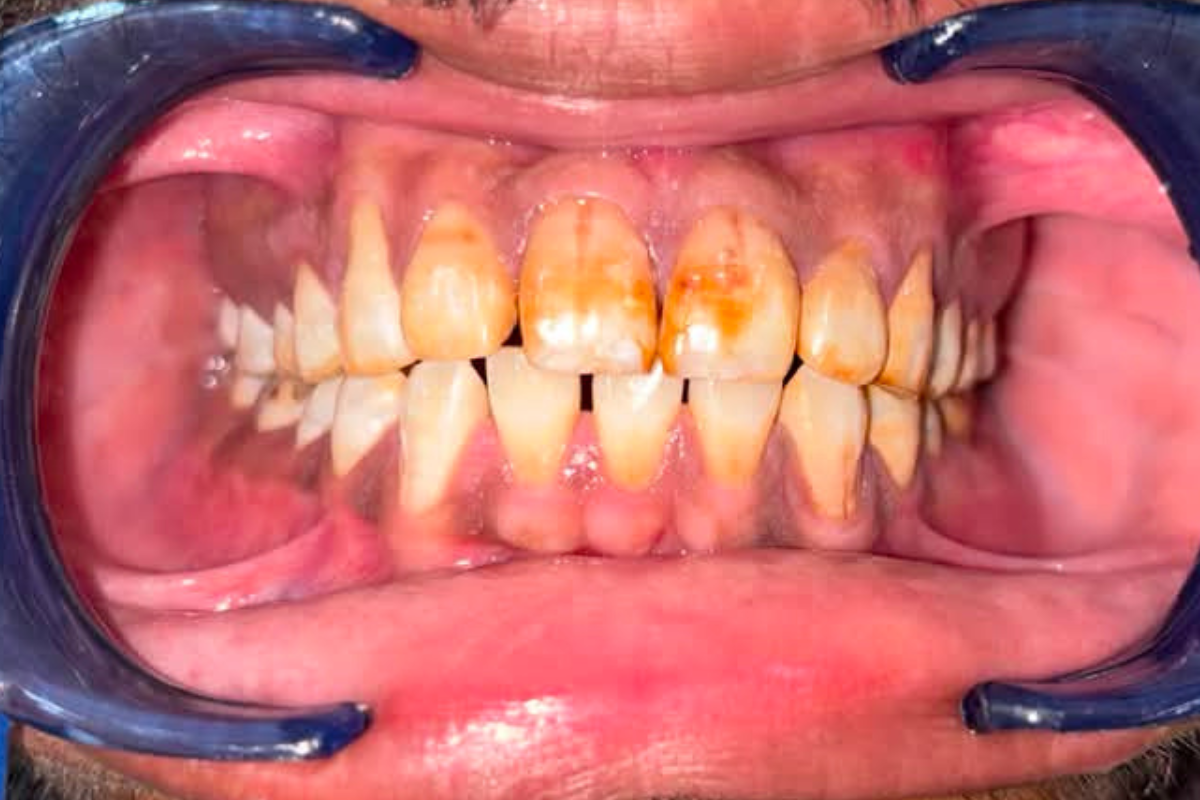 Before Treatment